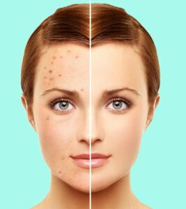 Best Natural Remedies to Reduce Acne Fast