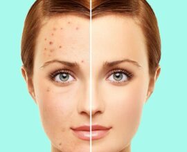 Best Natural Remedies to Reduce Acne Fast