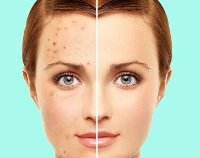 Best Natural Remedies to Reduce Acne Fast