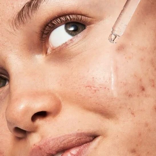 Effective Tips to Prevent Acne Breakouts 4 Acne Prevention