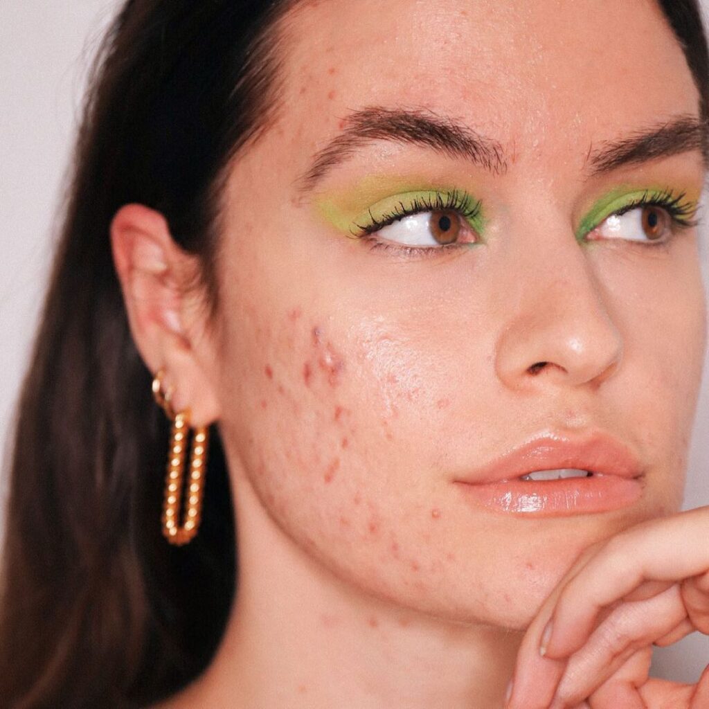 Skin Care Routine for Acne-Prone Skin 4 Acne-Prone Skin Care