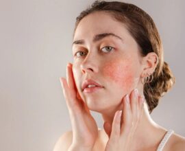 Foods That Help Control Acne Naturally