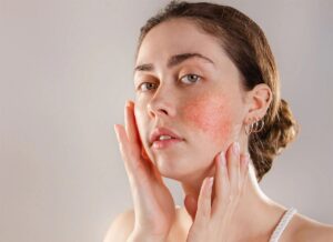 Foods That Help Control Acne Naturally