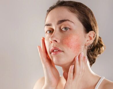 Foods That Help Control Acne Naturally