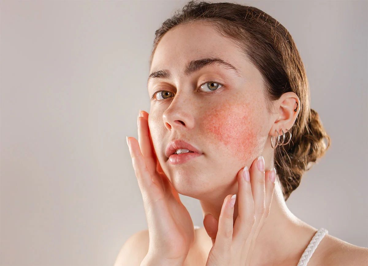 Foods That Help Control Acne Naturally