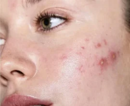 Effective Tips to Prevent Acne Breakouts