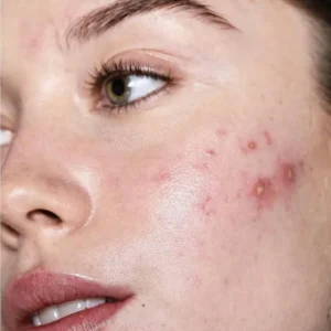 Effective Tips to Prevent Acne Breakouts