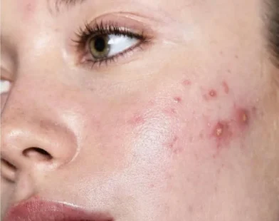 Effective Tips to Prevent Acne Breakouts