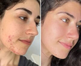 Top Treatments for Acne Scars and Marks
