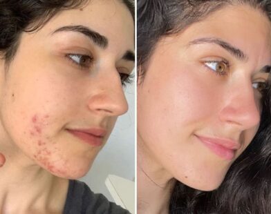 Top Treatments for Acne Scars and Marks