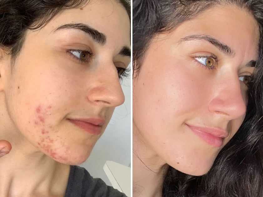 Top Treatments for Acne Scars and Marks