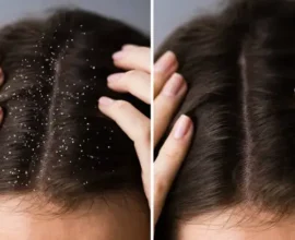 Treat Dandruff Naturally at Home