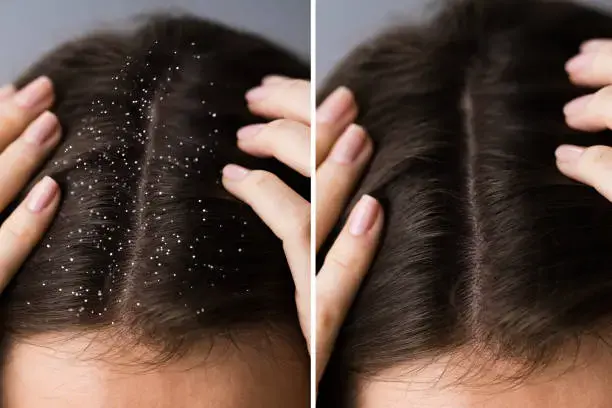 Treat Dandruff Naturally at Home