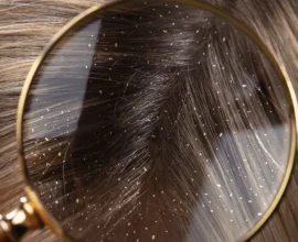 How to Treat Dandruff Naturally at Home