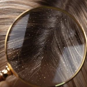 How to Treat Dandruff Naturally at Home