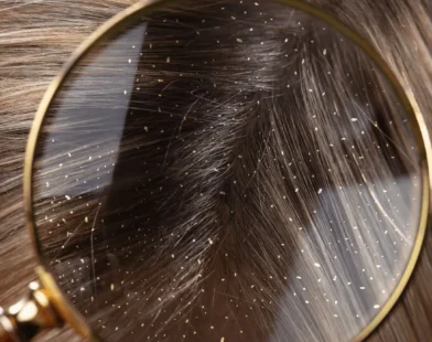 How to Treat Dandruff Naturally at Home
