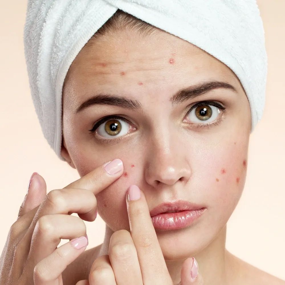 Face Care Tips for Oily and Acne-Prone Skin