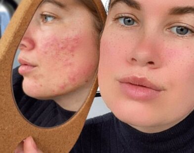 Homemade Tips for Reducing Pimples and Acne