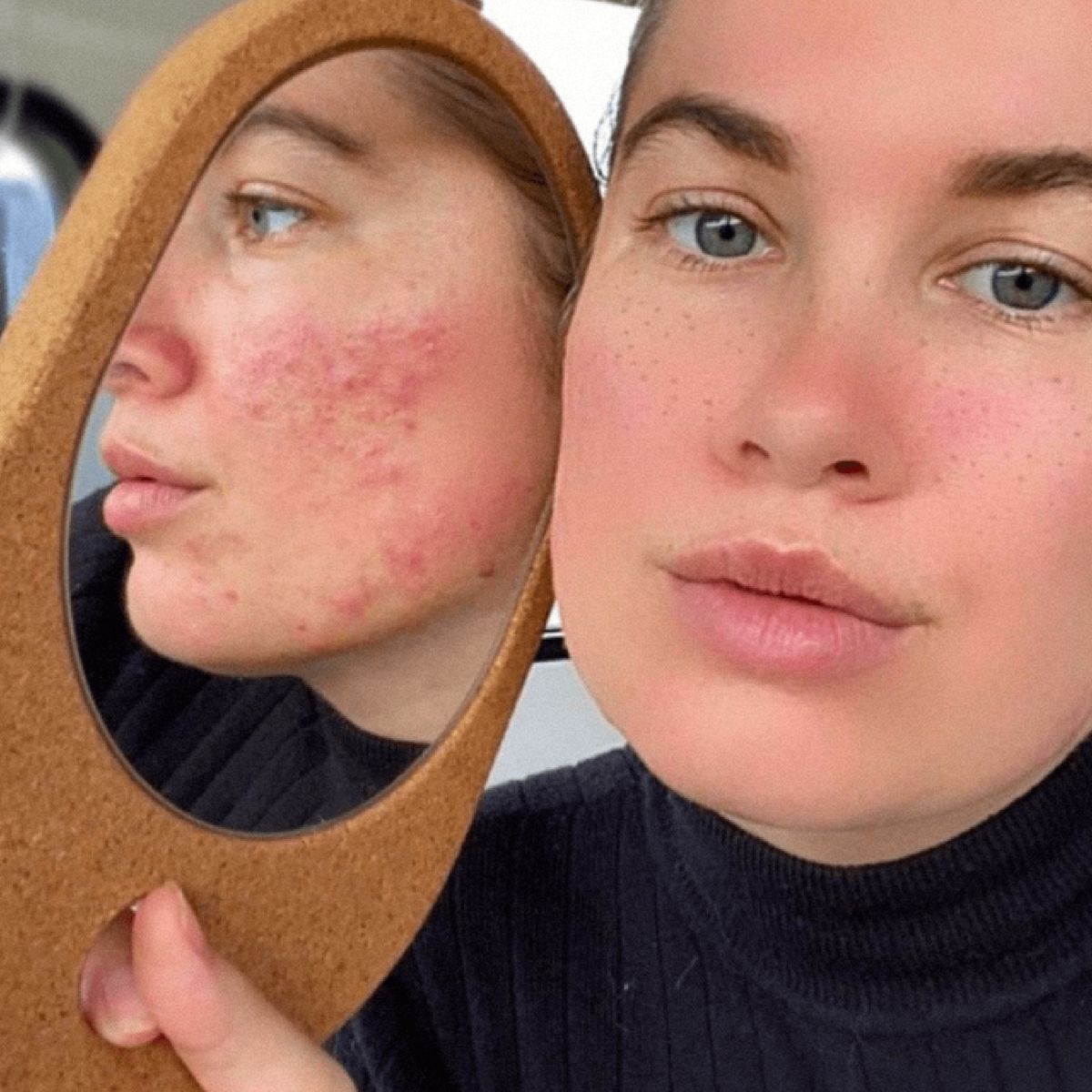 Homemade Tips for Reducing Pimples and Acne