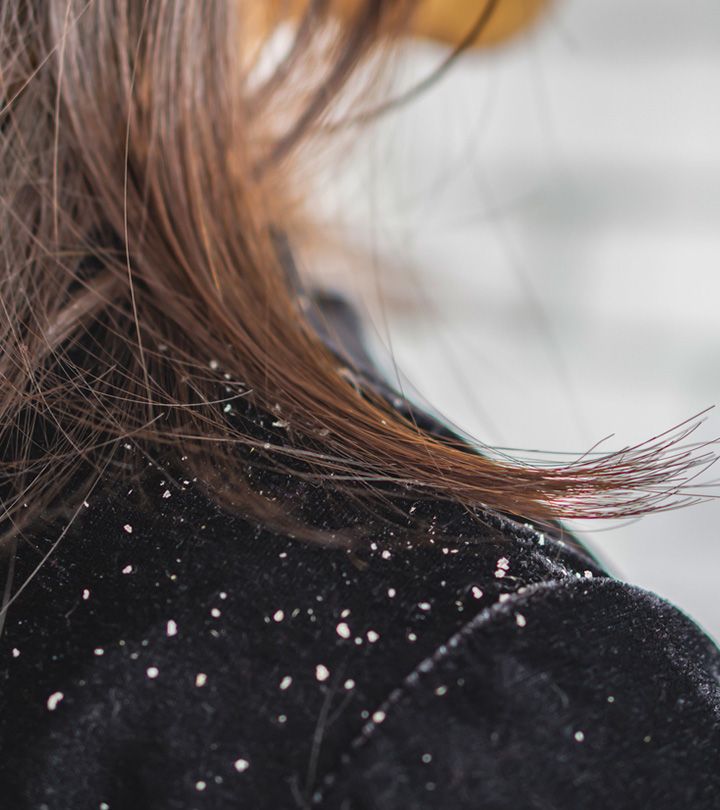 Effective Tips to Stop Dandruff Permanently 4 hair