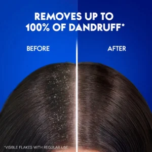 Top Shampoos for Dandruff-Free Healthy Hair