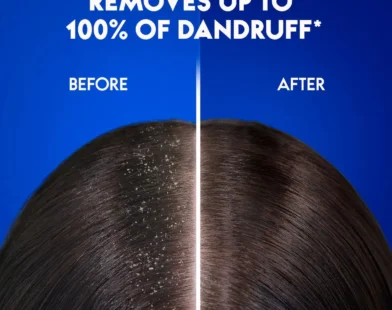 Top Shampoos for Dandruff-Free Healthy Hair