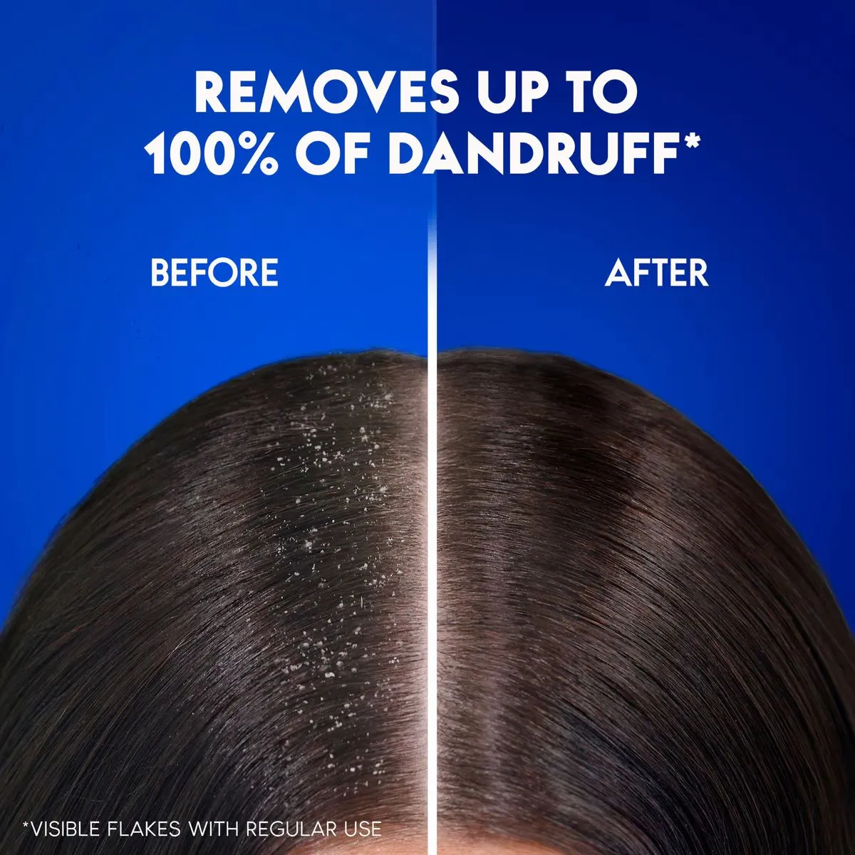 Top Shampoos for Dandruff-Free Healthy Hair