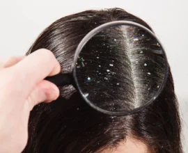 Effective Tips to Stop Dandruff Permanently