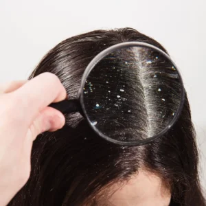 Effective Tips to Stop Dandruff Permanently