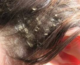 Best Home Remedies for Dandruff Control