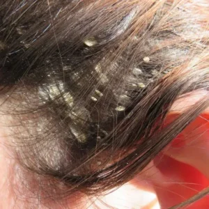 Best Home Remedies for Dandruff Control