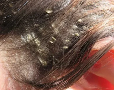 Best Home Remedies for Dandruff Control